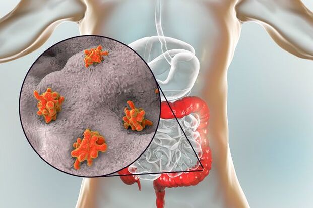 Tipos de parásitos en el cuerpo humano.