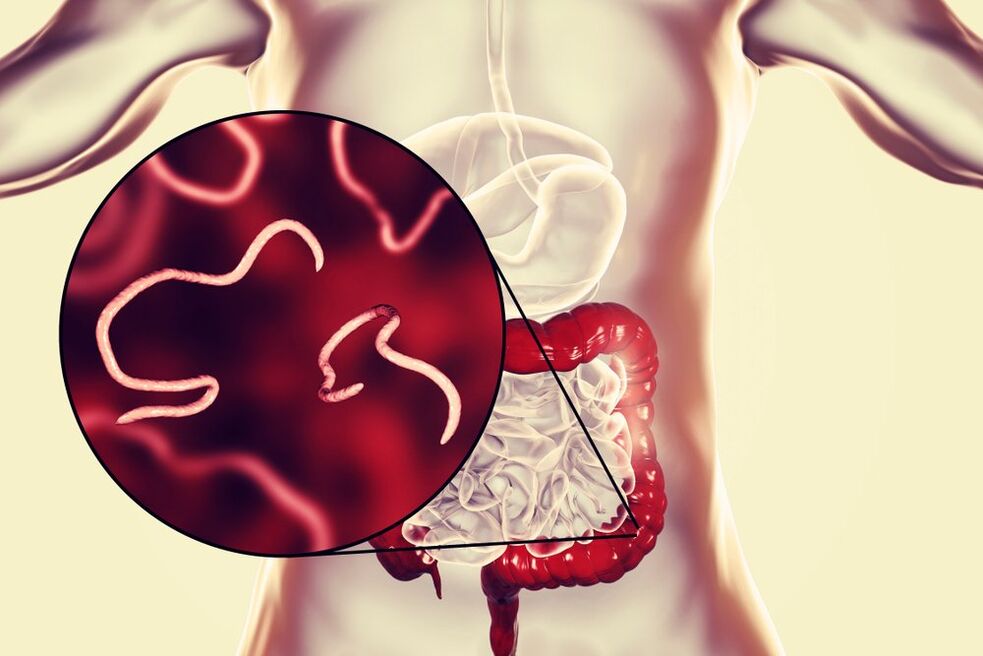 Gusanos en el intestino humano.